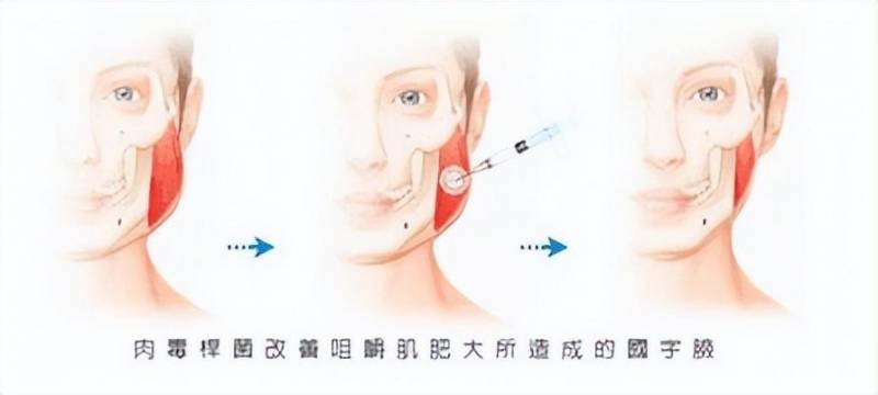 面部轮廓整形有哪些术式（面部轮廓整形需要多少钱）