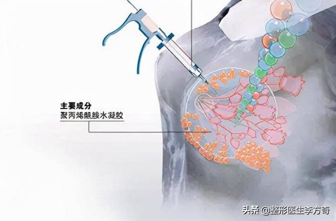 僅需15分鍾的假躰隆胸手術（隆胸注射物能取出乾淨嗎）