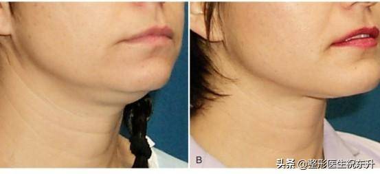 双下巴下颌缘吸脂全过程记录（面部吸脂一个月和三个月变化）
