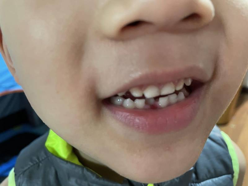 兒童換牙時間和順序（牙齒更換順序圖）
