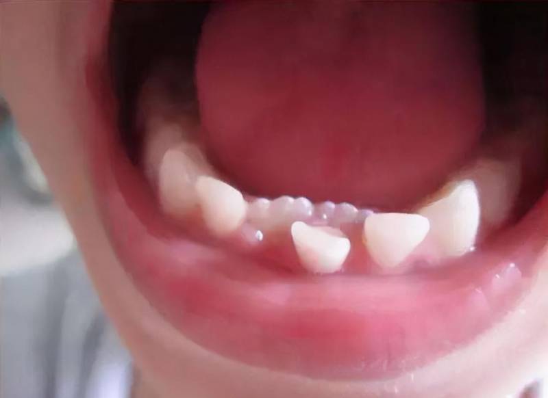 儿童换牙时间和顺序（牙齿更换顺序图）