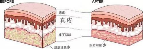 自体脂肪丰胸手术详细过程揭秘图（做了两次自体脂肪隆胸没效果）