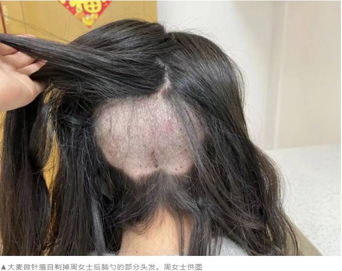 大麦南京的微博，揭秘南京大麦微针植发医院真实体验