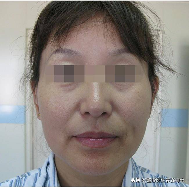 面部皱纹最有效的去除方法，比较除皱针、玻尿酸与自然疗法