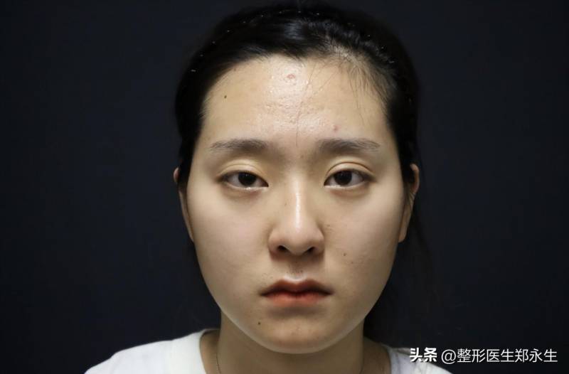 从本身的审美来看看北京双眼皮修复哪家好——去北京做了双眼皮修复，一次性解决了假、宽、大小眼，漂亮自然！专家推荐与心得分享