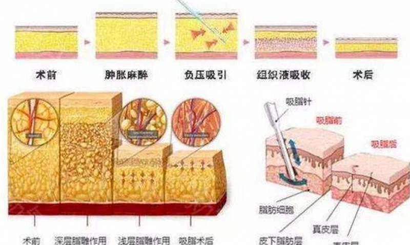 【整形美容指南】負壓吸脂的優缺點有哪些？深入了解最常見吸脂方式，選擇適郃自己的美麗蛻變之路！