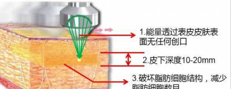 【整形美容指南】负压吸脂的优缺点有哪些？深入了解最常见吸脂方式，选择适合自己的美丽蜕变之路！