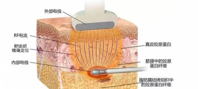 【整形美容指南】负压吸脂的优缺点有哪些？深入了解最常见吸脂方式，选择适合自己的美丽蜕变之路！