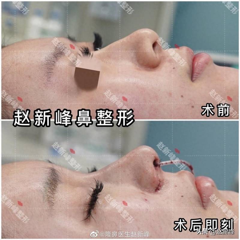 北京鼻头塑形新潮流，大鼻头女孩亲身体验赵院隆鼻，惊叹，完美鼻型才是整形艺术的极致！