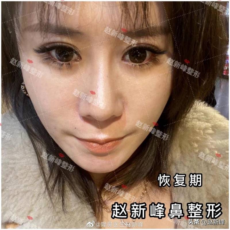 北京鼻头塑形新风尚，大鼻头女孩亲身体验赵院独家技术，感叹，完美鼻型，隆鼻才是整形艺术的巅峰！