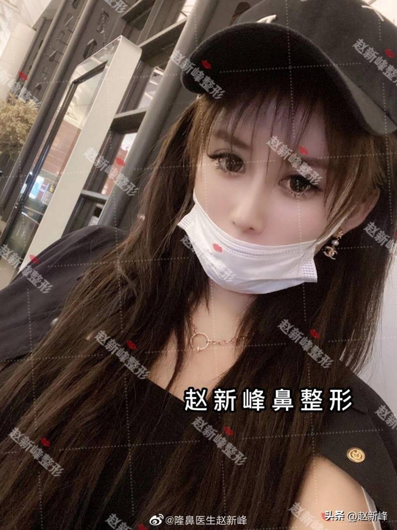 北京鼻头塑形新风尚，大鼻头女孩亲身体验赵院独家技术，感叹，完美鼻型，隆鼻才是整形艺术的巅峰！