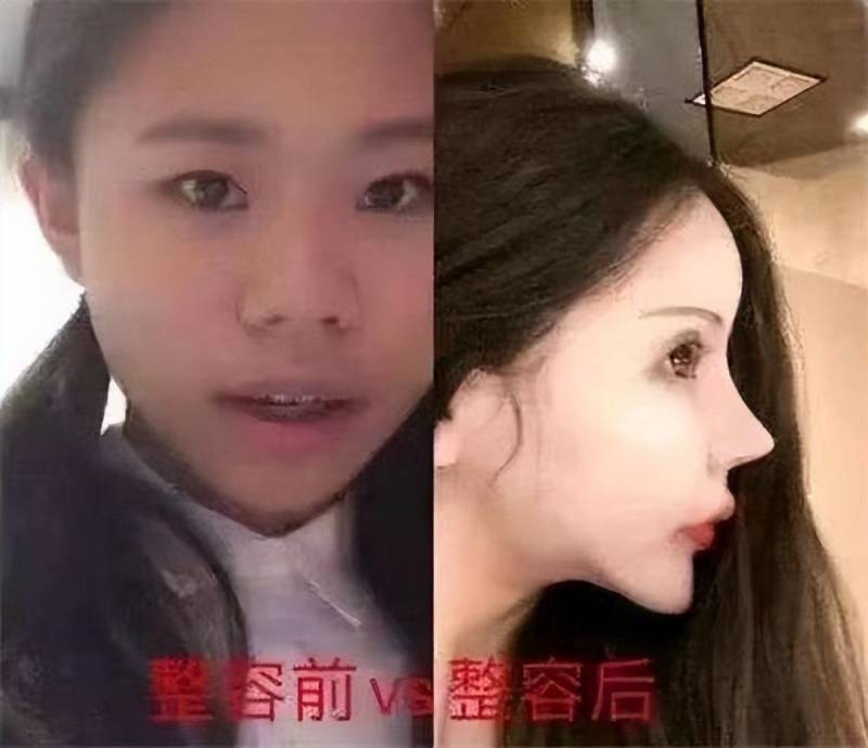 女性丰胸网微博热议，女主播勇敢直播丰胸手术全程，直击畸形审美，引发11000网友关注与思考