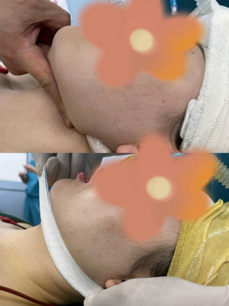 大臉妹子你的下頜角過大怎麽辦呢？咬肌、脂肪、下頜角肥大導致的臉大，應該怎麽改善？