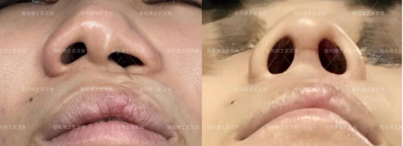唇裂导致的鼻翼塌陷畸形怎么办，探讨二期修复与预防再塌陷策略