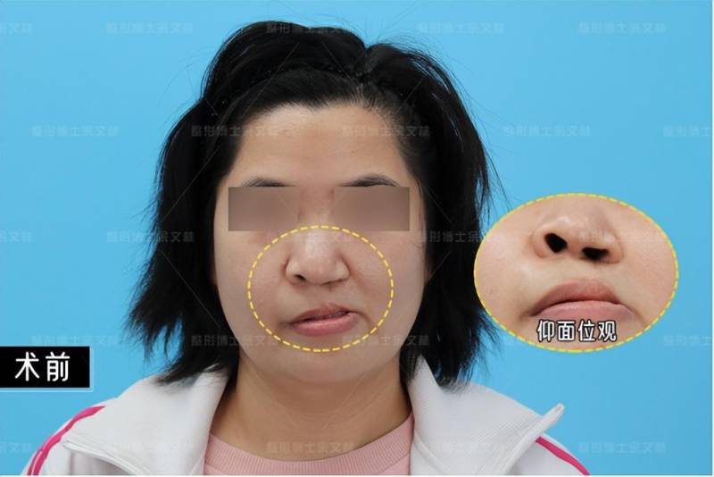 唇裂导致的鼻翼塌陷畸形怎么办，探讨二期修复与预防再塌陷策略