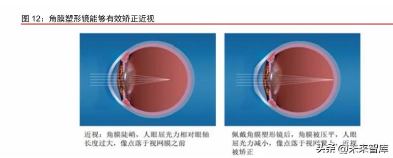 MiSight软性亲水接触镜摘镜指南，安全护理新篇章，呵护双眼的选择之道