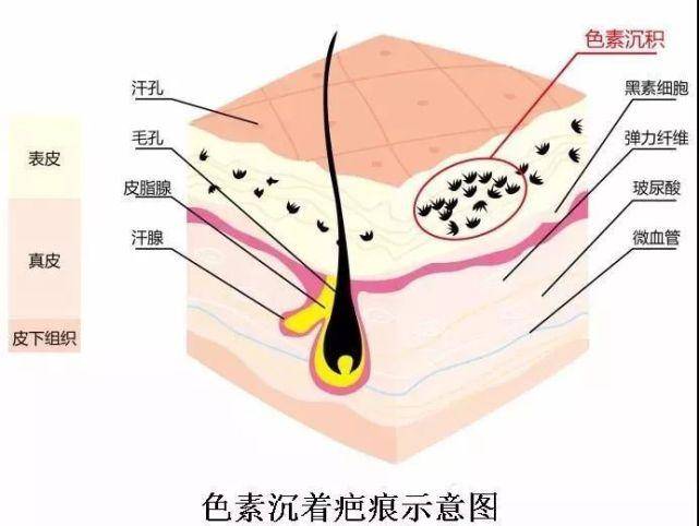 肤疾宁贴膏能治疗瘢痕疙瘩吗？专家建议，配合这3个方法，更能促进瘢痕疙瘩的淡化