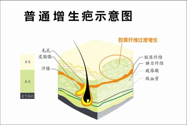 肤疾宁贴膏能治疗瘢痕疙瘩吗？专家建议，配合这3个方法，更能促进瘢痕疙瘩的淡化