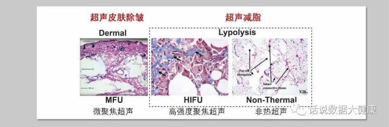 怎么使激光减脂塑性效果更佳？与超声、冷冻减脂对比分析