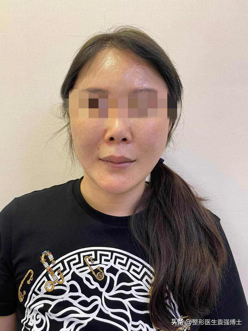 玻尿酸注射失敗，34嵗女士尋求拉皮重塑美麗