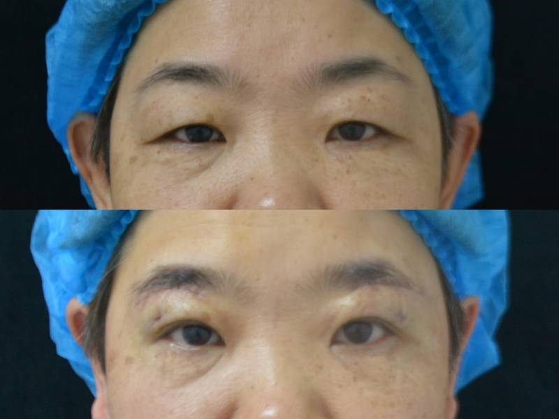 做双眼皮手术渴望眼睛变大，术后两年效果依然明显！