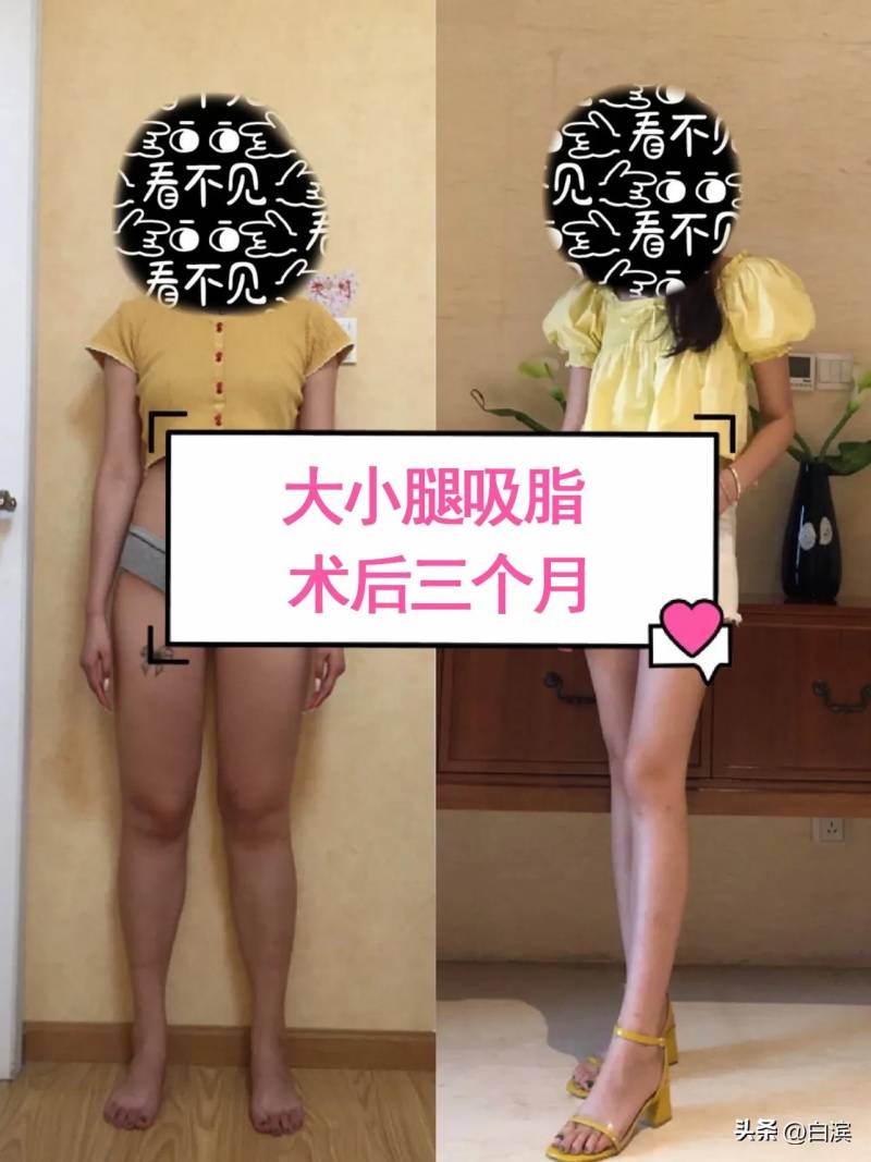 这期是北京大腿吸脂，模特美女追求完美身材的选择