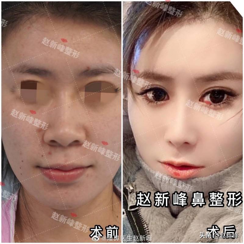 北京鼻头塑形新趋势，大鼻头女孩亲述变美经历，选择赵院隆鼻，发现整形新境界！