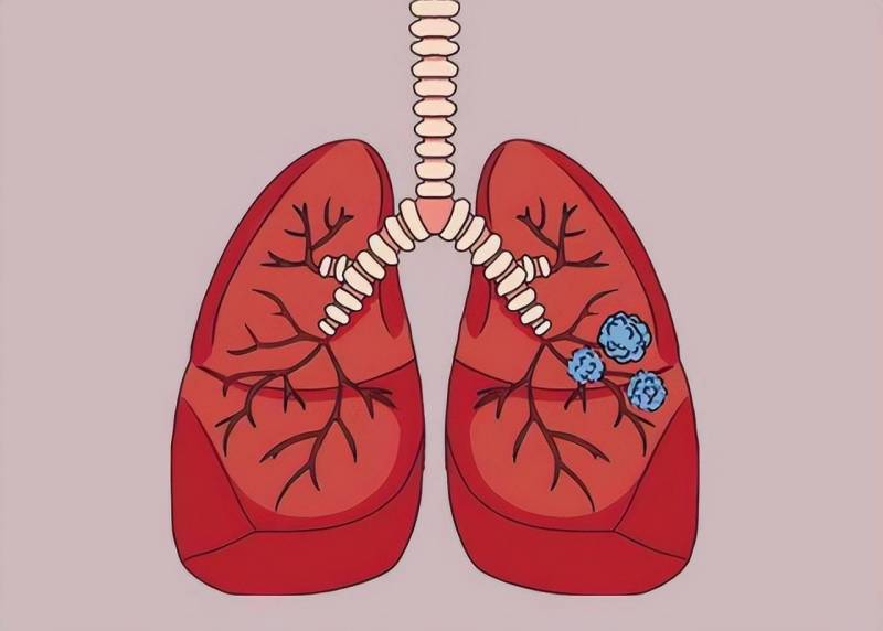 科兴肺结节？网友反映疫苗接种后问题，专家回应真相