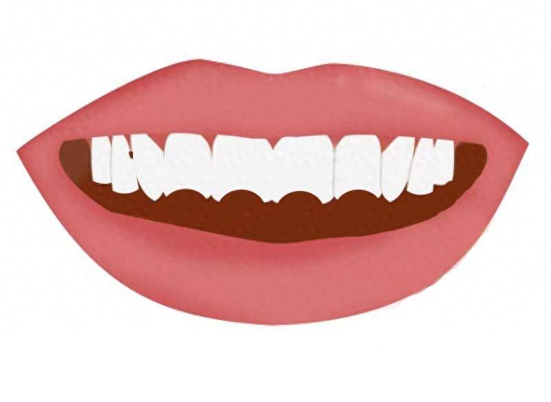 牙齒呈半月形，警惕梅毒感染征兆