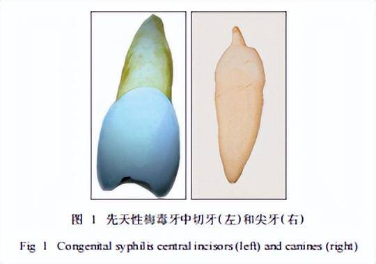 牙齒呈半月形，警惕梅毒感染征兆