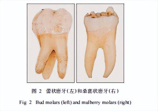 牙齒呈半月形，警惕梅毒感染征兆