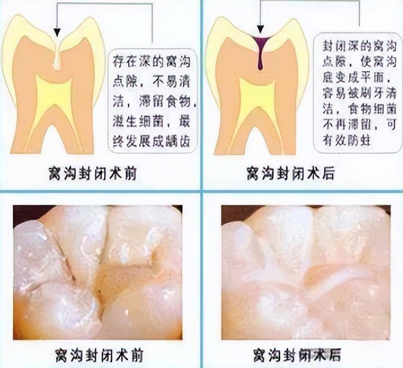 特纳牙早预防，晚治疗！关键护牙技巧不可少