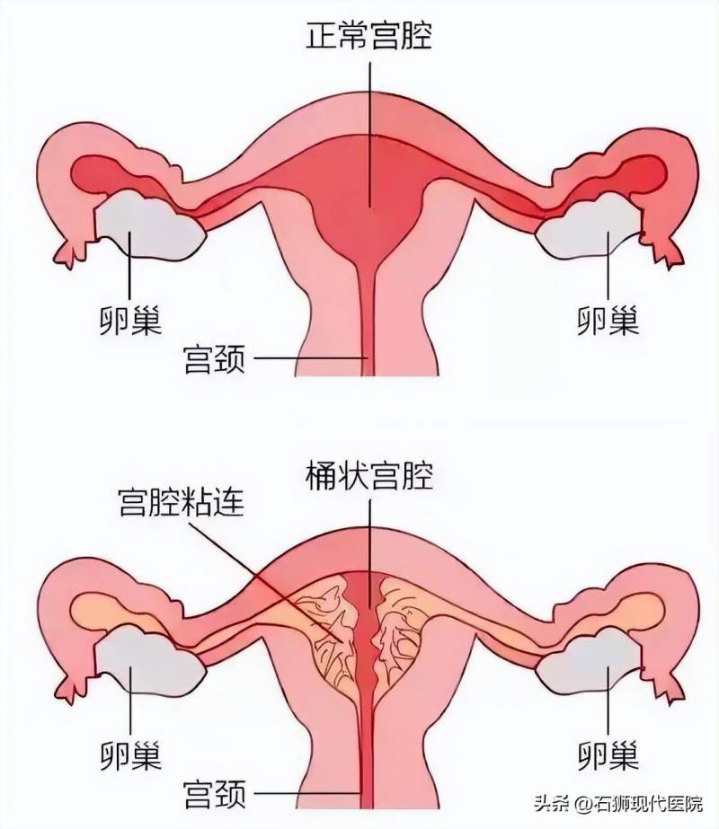 人流原來是這樣 認識5個事實，不再輕眡小手術