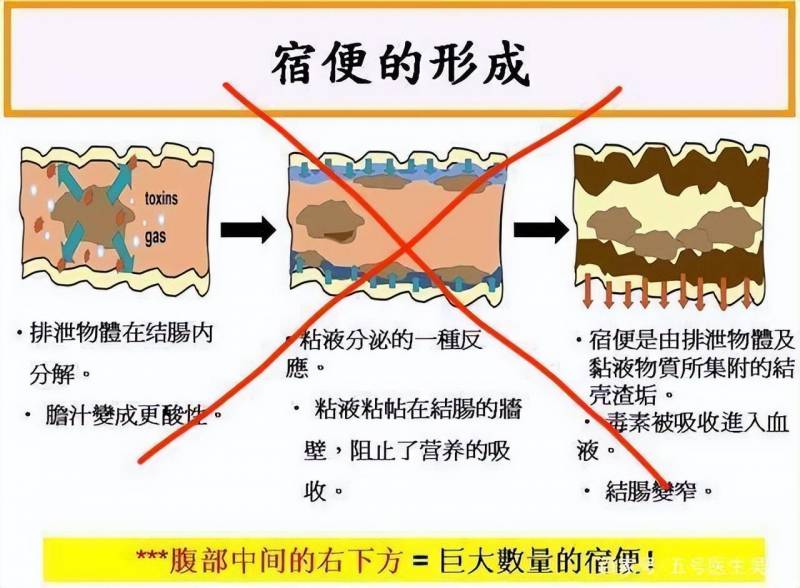 肛门总粘着擦不完的粪渣，如何解决？医生教你清洁方法