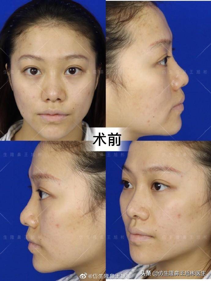 广州隆鼻靠谱专家一览，广州鼻修复厉害名医推荐