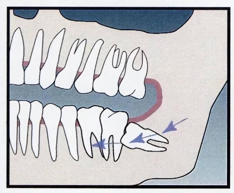 脸小居然会导致牙齿不齐，原来是进化惹的祸？