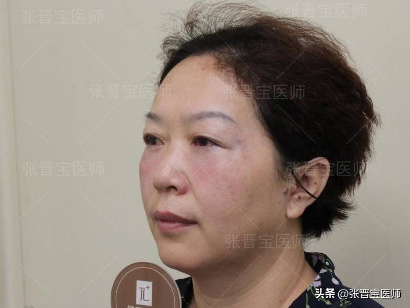 不得不提的上海眼整形攻略，30分钟摆脱眼袋，术后7天美艳转身