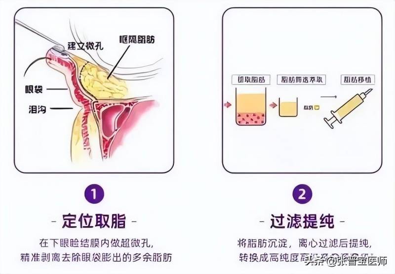 不得不提的上海眼整形攻略，30分钟摆脱眼袋，术后7天美艳转身