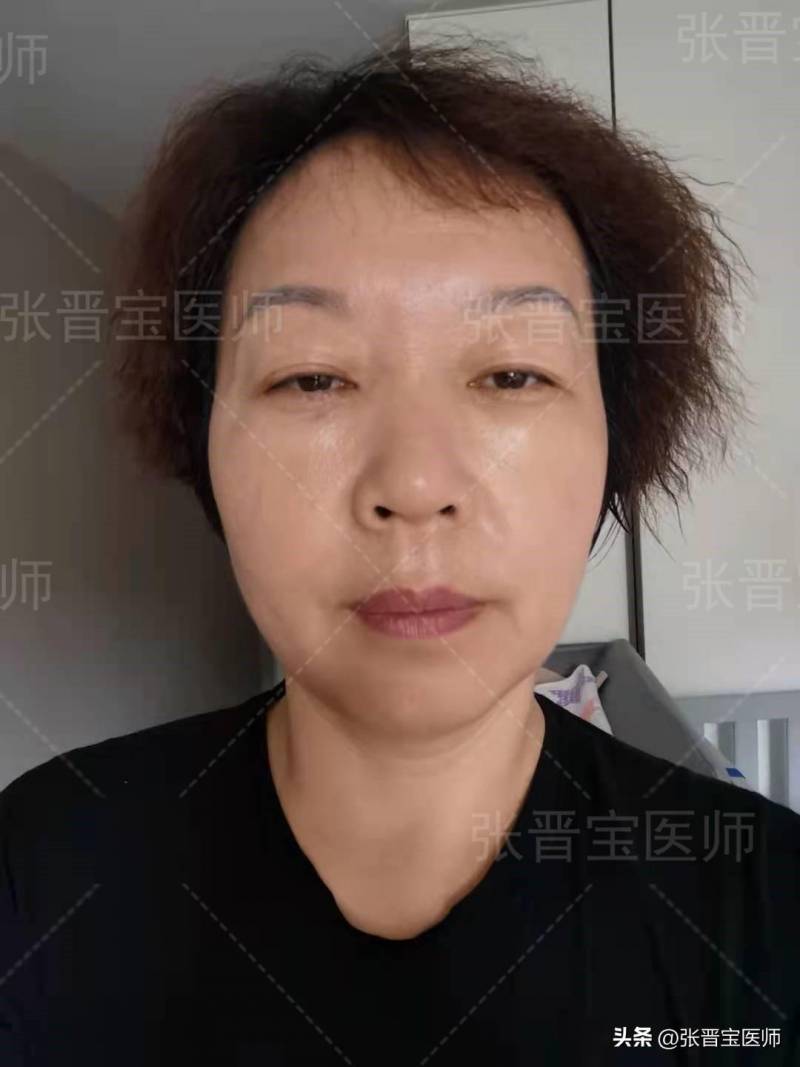 不得不提的上海眼整形攻略，30分钟摆脱眼袋，术后7天美艳转身