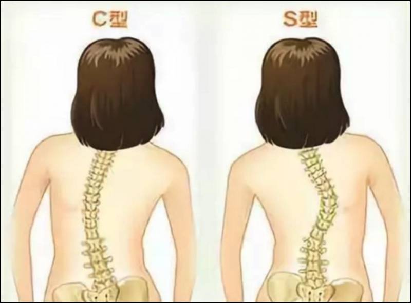 脊柱側凸了解危害與預防，全麪認識脊椎健康