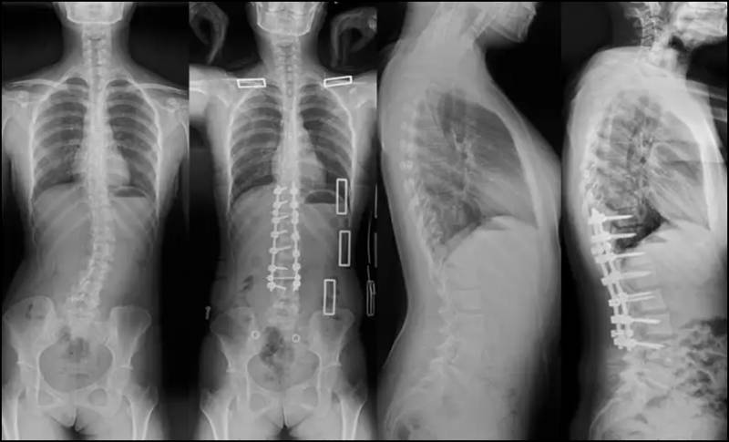 脊柱侧凸了解危害与预防，全面认识脊椎健康 