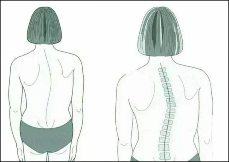 脊柱侧凸了解危害与预防，全面认识脊椎健康 