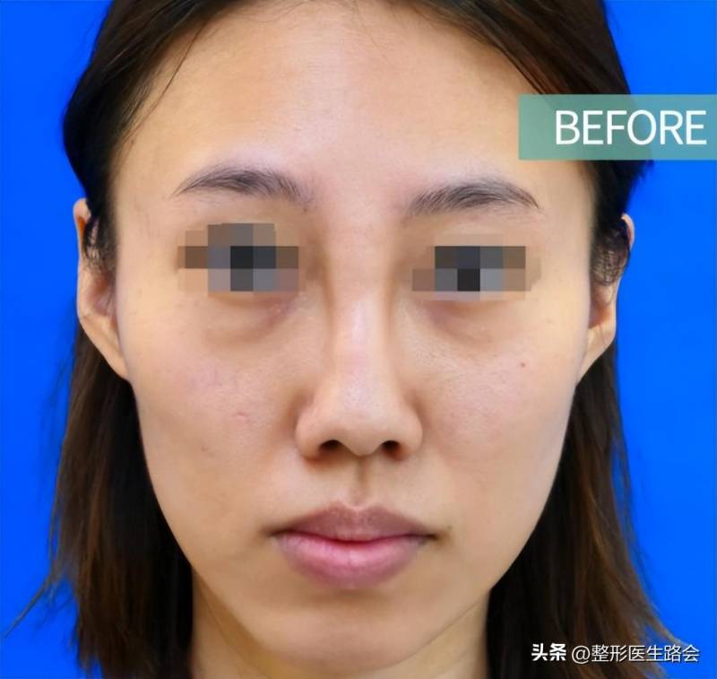 北京隆鼻哪家好？北京鼻修复靠谱专家，拯救29岁骨粉隆鼻问题