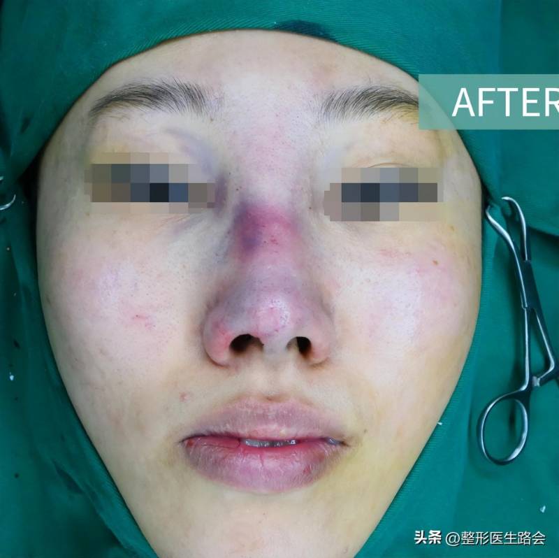 北京隆鼻哪家好？北京鼻修复靠谱专家，拯救29岁骨粉隆鼻问题