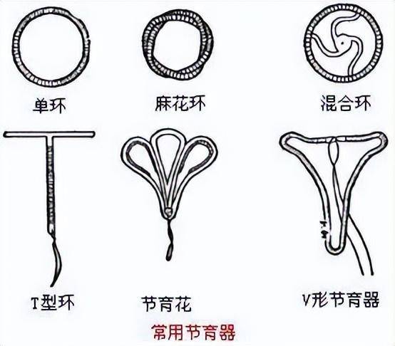 隂道避孕環真的有用嗎？了解其利弊與適用性