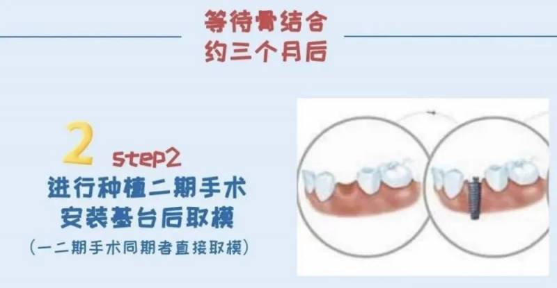 种牙篇，安心种牙，全流程详解指南→